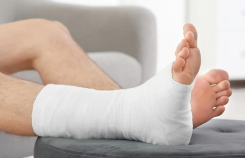 broken leg